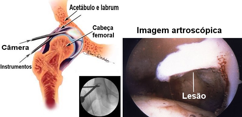 Artroscopia